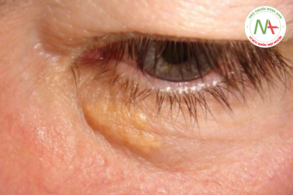 Tình trạng mắt của bệnh nhân
