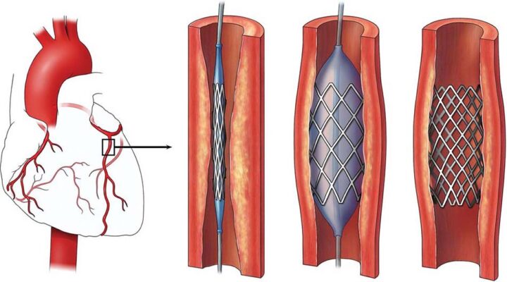 So sánh vai trò bắt cầu mạch vành và can thiệp mạch vành qua da