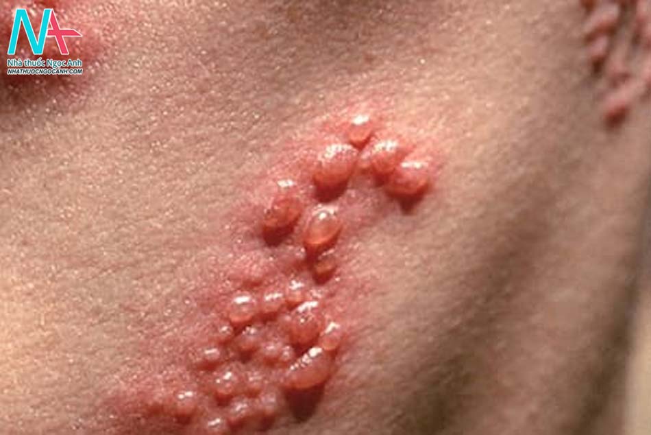 Bệnh lậu là một bệnh nhiễm khuẩn do một loại vi khuẩn có tên là lậu cầu Neisseria gonorrhoeae gây ra