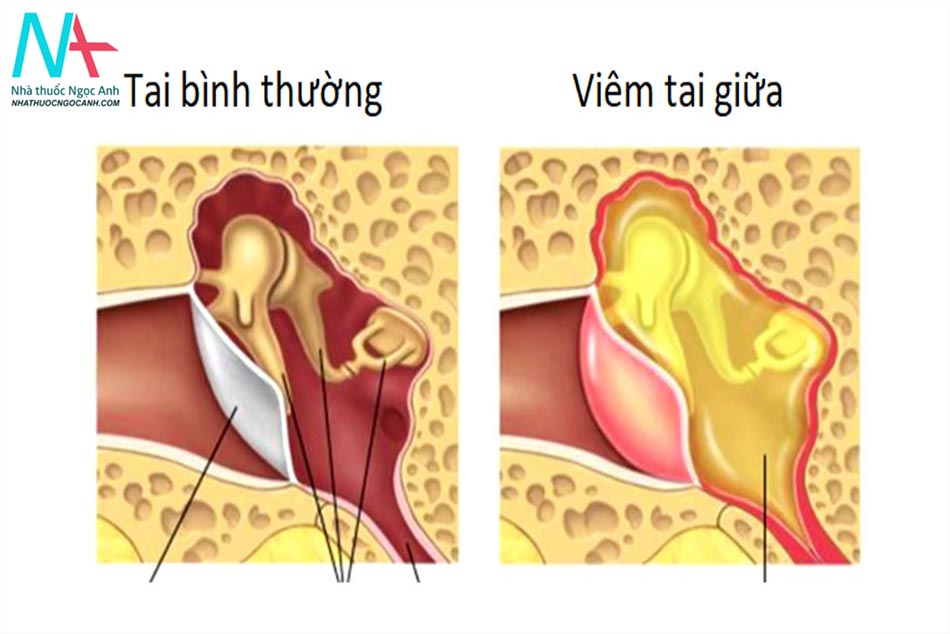 Viêm tai giữa là biến chứng của viêm VA ở trẻ
