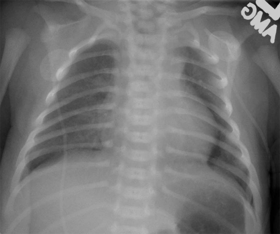 Neonatal spontaneous pneumothorax: tràn khí màng phổi tự phát ở sơ sinh