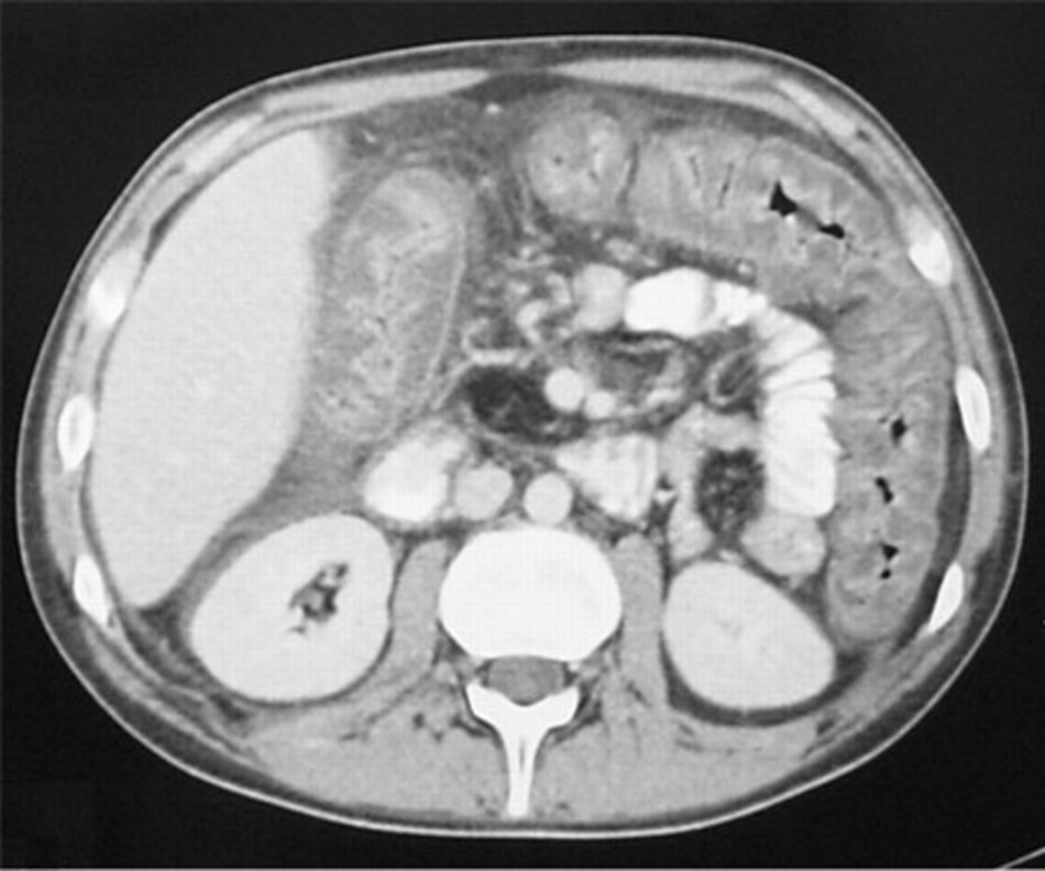 Hình 1: CT vùng bụng chỉ ra tình trạng dày vách ruột già rõ ràng và phá hủy lòng ruột