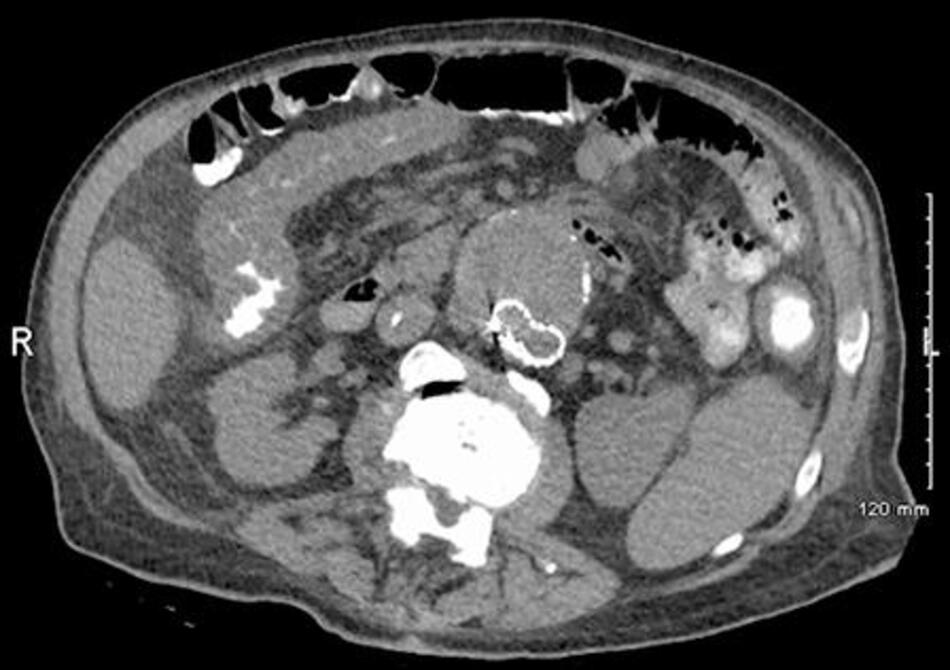 Hình 2: CT vùng bụng chỉ ra tình trạng dày ruột lan tỏa cho thấy nguy cơ viêm đại tràng