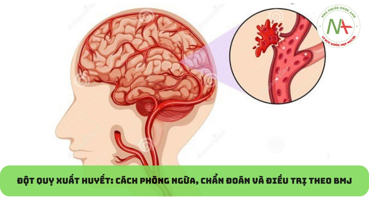 Đột quỵ xuất huyết: cách phòng ngừa, chẩn đoán và điều trị theo BMJ