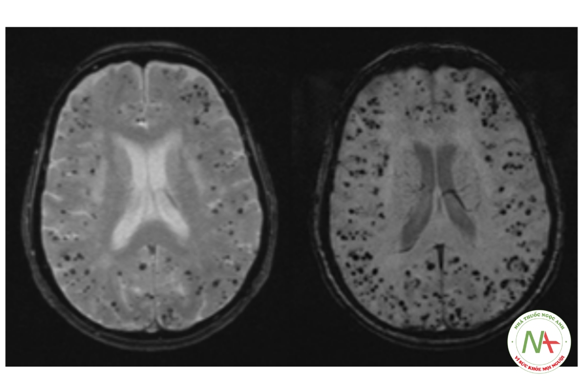 Hình 3: Một bệnh nhân nữ 80 tuổi với nhiều đốm chấm giảm cường độ (đốm đen) trên chuỗi xung dội gradient MRI GRE) (trái), gợi ý nhiều vi xuất huyết thùy do bệnh mạch máu não amyloid gây ra. Chuỗi hình ảnh trọng số nhạy cảm (SWI) MRI (phải) cho thấy thêm nhiều vi xuất huyết không quan sát thấy trên chuỗi GRE Tập dữ liệu cá nhân của Trung tâm y tế Foothills; đã được phép sử dụng