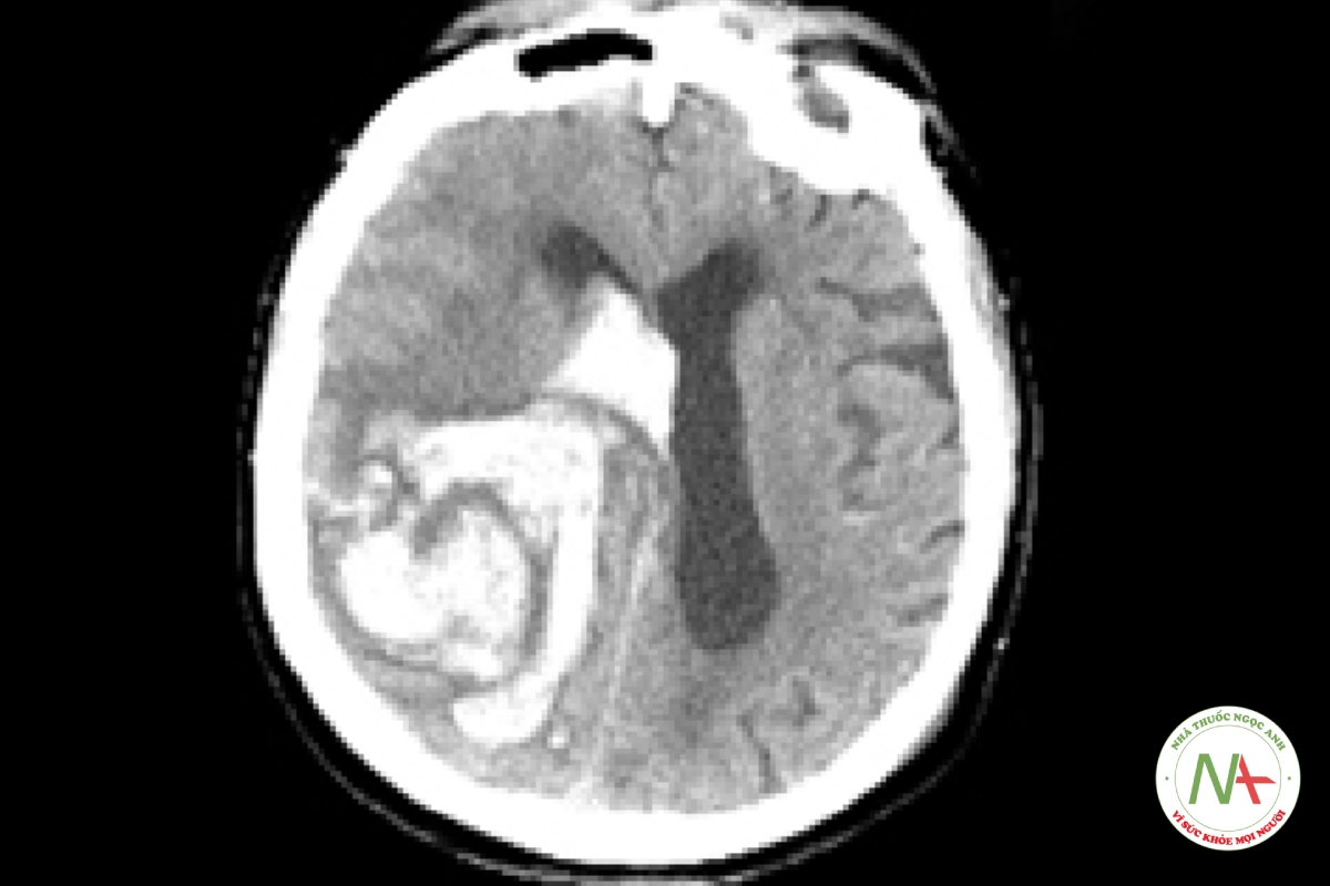 Hình 1: Xuất huyết nội sọ trên ảnh chụp CT Tập dữ liệu cá nhân của Bệnh viện đa khoa Massachusetts; đã được phép sử dụng