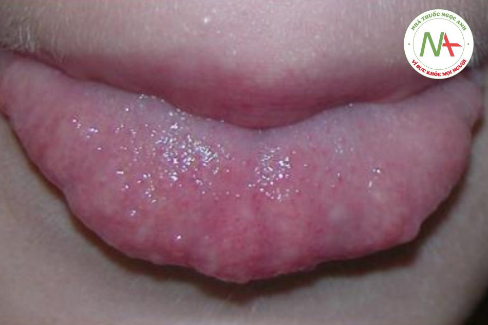 Tình trạng lưỡi của bệnh nhân