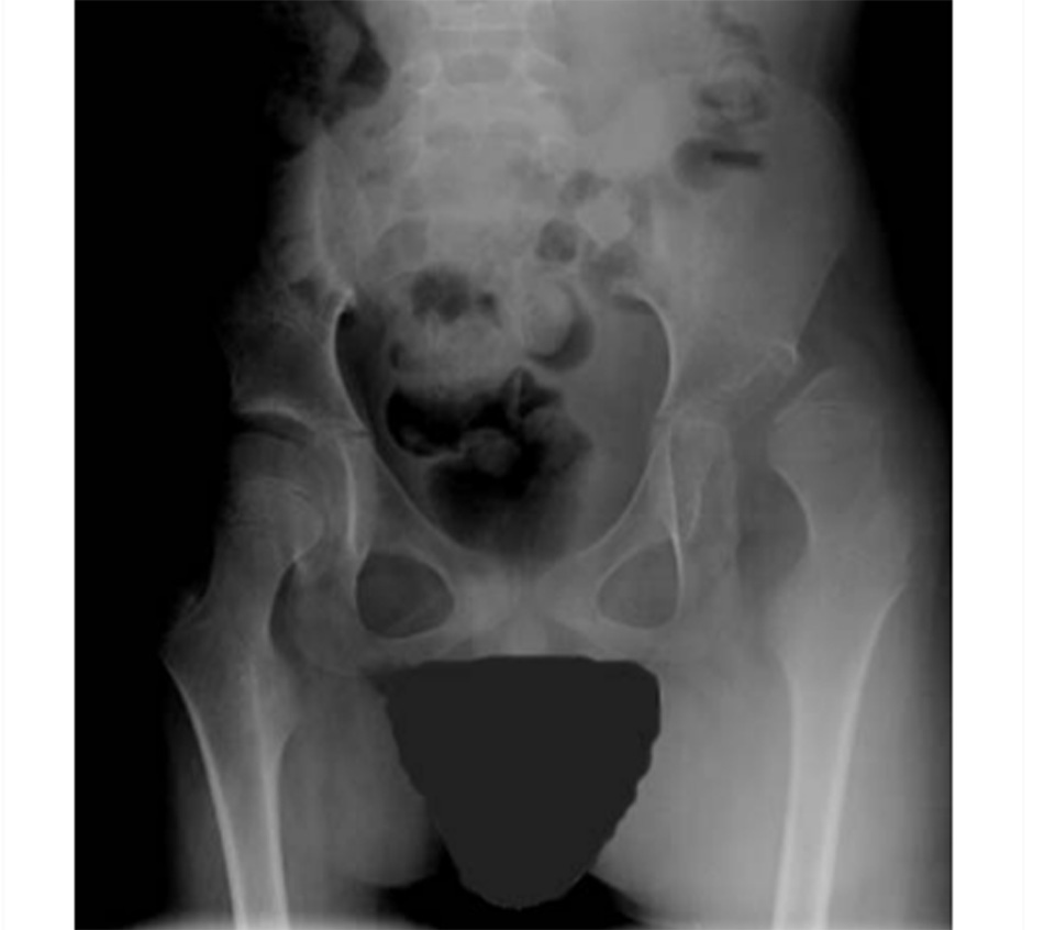 Hình 2: Trật khớp hông ở bệnh nhân bị bại não Từ thông tin thu thập của William L. Oppenheim; đã được phép sử dụng
