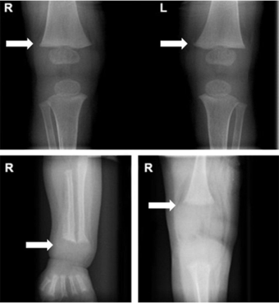 Hình 2: Thay đổi xương (mũi tên) trước (bảng dưới) và sau khi (bảng trên) điều trị bệnh còi xương