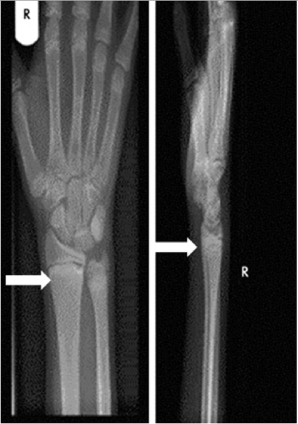 Hình 3: Cố tay phải của bệnh nhân có bệnh còi xương do thiếu vitamin D sau khi điều trị (mũi tên)