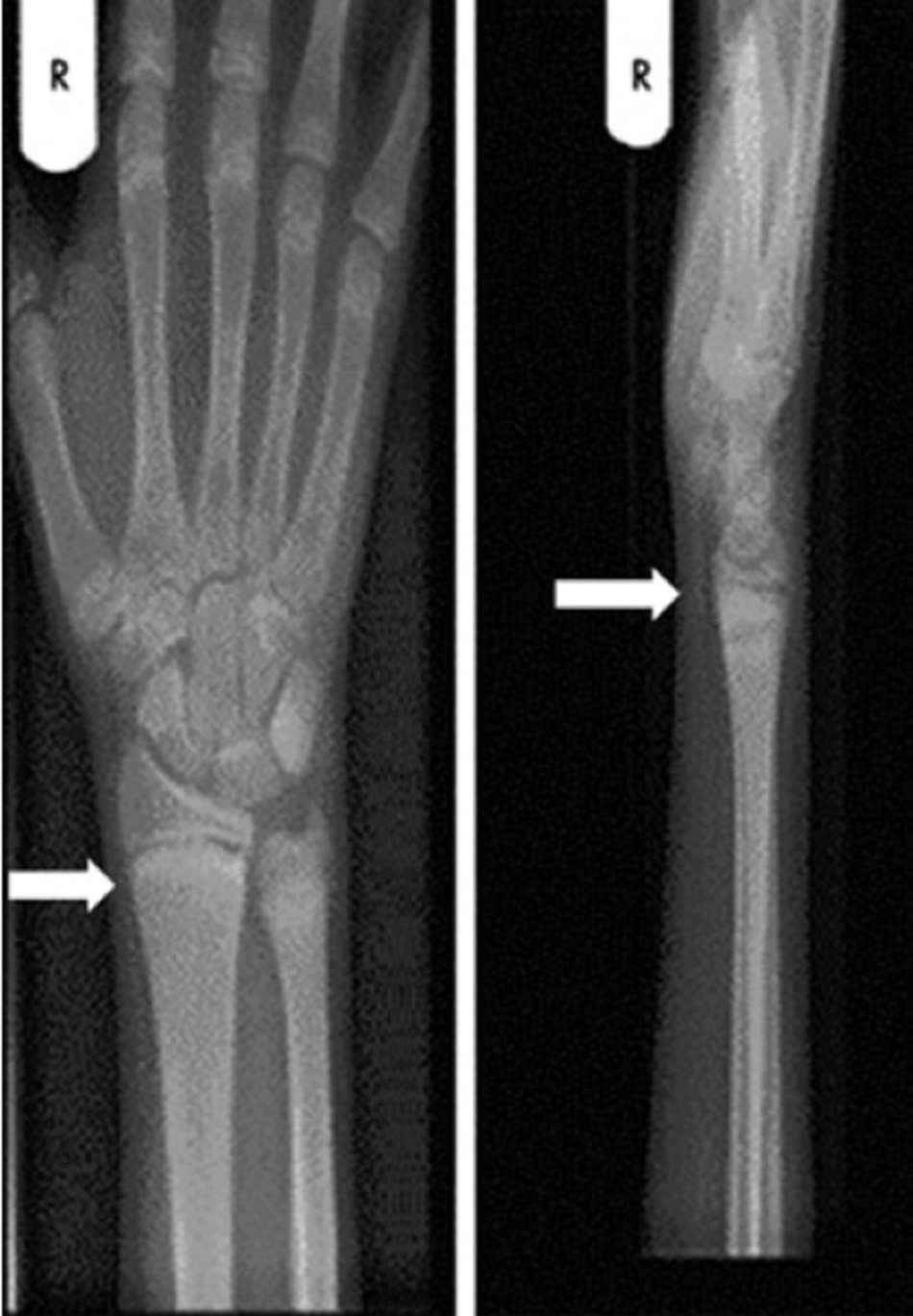 Hình 4: Cố tay phải của bệnh nhân có bệnh còi xương do thiếu vitamin D trước khi điều trị ta thấy đĩa tận cùng của xương quay và xương khuỷu tay xơ cứng và mở rộng (mũi tên)