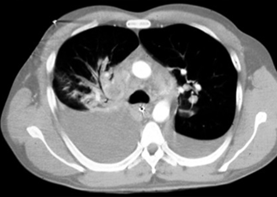 Hình 4: Chụp CT ngực cho thấy bệnh hạch bạch huyết vùng rốn gan, thâm nhiễm vùng rốn gan, và trung thất mở rộng Borio et al. JAMA. 2001;286:2554-2559