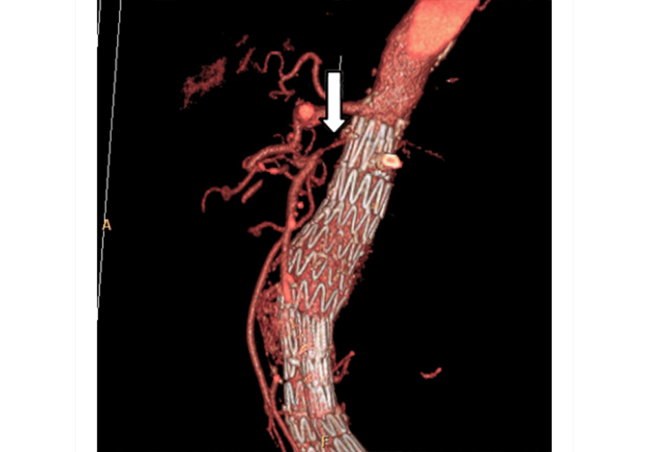 Hình 10: Chụp CT mạch máu: tái tạo lại hình ảnh 3 chiều của tình trạng hẹp động mạch mạc treo tràng trên do mảng xơ vữa động mạch lớn, đây là hình ảnh chụp khi theo dõi hình ảnh của bệnh nhân đang được điều trị chứng phình mạch Trích từ tư liệu Tiến sĩ Jennifer Holder-Murray; đã được phép sử dụng