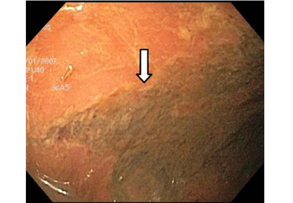 Hình 11: Nội soi đại tràng: ranh giới giữa đại tràng bị thiếu máu và đại tràng bình thường Trích từ tư liệu Tiến sĩ Jennifer Holder-Murray; đã được phép sử dụng