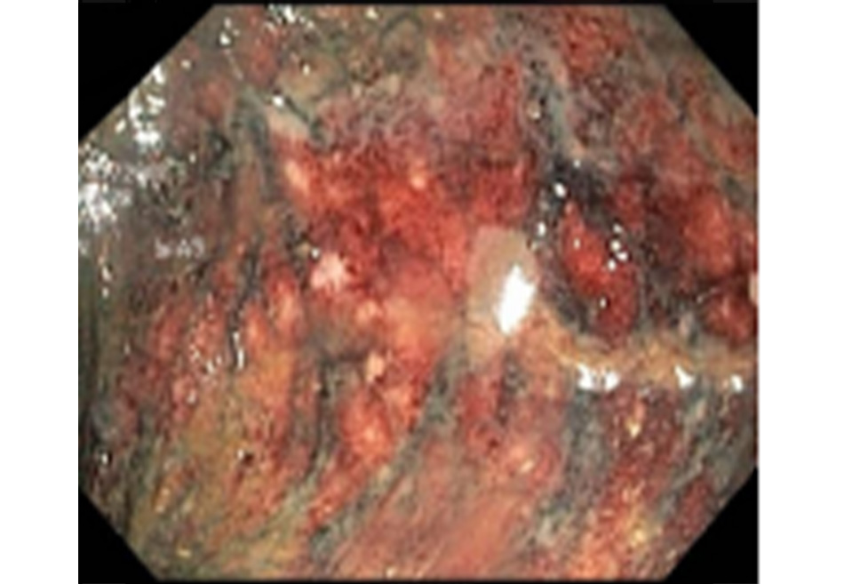 Hình 12: Nội soi đại tràng: hình ảnh bóc tách lớp niêm mạc đại tràng