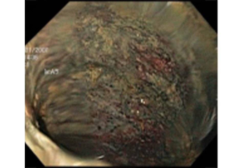 Hình 13: Nội soi đại tràng: hình niêm mạc bị tróc ra và có khả năng là đại tràng không còn sống được Trích từ tư liệu Tiến sĩ Jennifer Holder-Murray; đã được phép sử dụng
