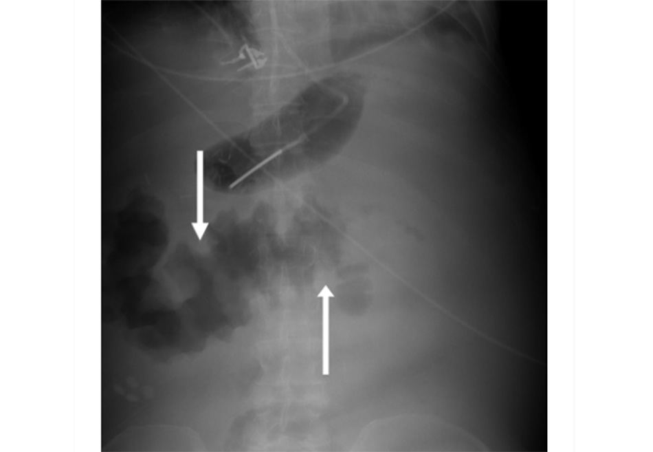 Hình 5: X quang bụng không sửa soạn: thành đại tràng ngang dày lên đáng kể, tương ứng với dấu ấn ngón tay cái (mũi tên màu trắng) Trích từ tư liệu của Tiến sĩ Amir Bastawrous; đã được phép sử dụng