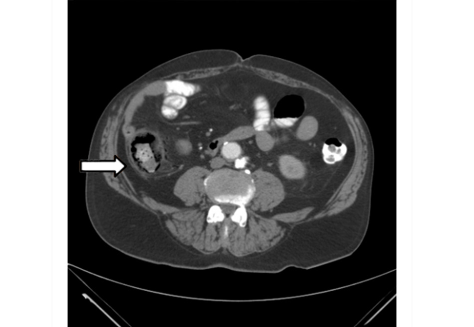 Hình 6: Chụp CT: dày thành đại tràng kèm trướng hơi bên trong ruột Trích từ tư liệu Tiến sĩ Jennifer Holder-Murray; đã được phép sử dụng