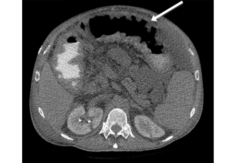Hình 8: Chụp CT: dày chu vi thành đại tràng ngang; mũi tên màu trắng là dấu ấn ngón tay cái Trích từ tư liệu của Tiến sĩ Amir Bastawrous; đã được phép sử dụng