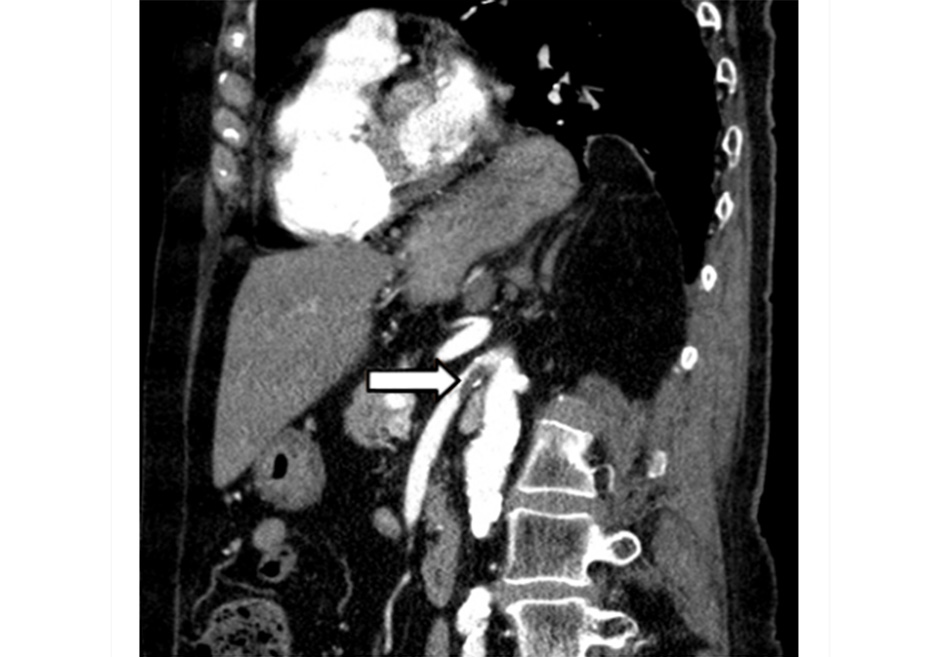 Hình 9: Phim chụp CT mạch máu: Huyết khối động mạch mạc treo tràng trên cấp tính Trích từ tư liệu Tiến sĩ Jennifer Holder-Murray; đã được phép sử dụng