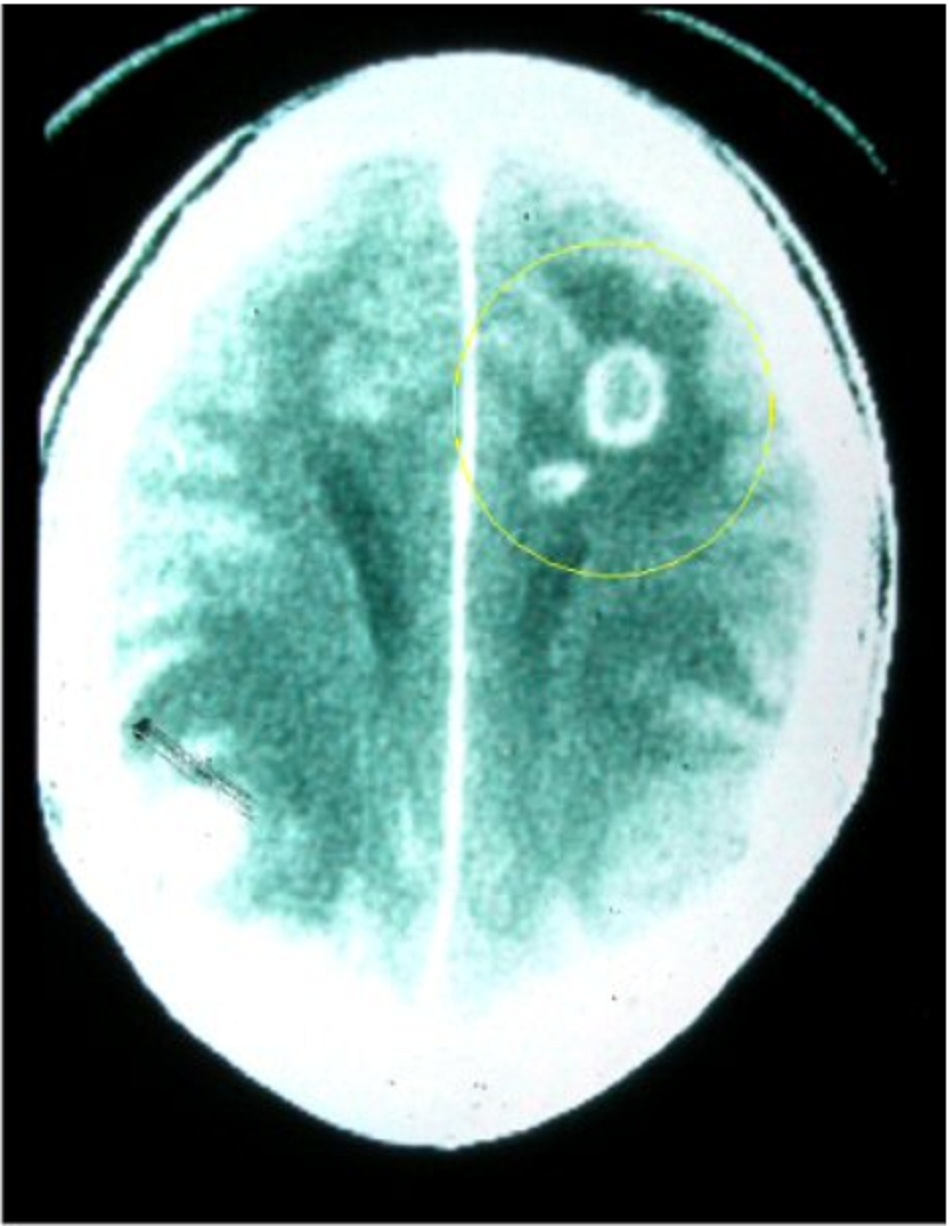 Hình 1: CT não trong bệnh Toxoplasma hệ thần kinh trung ương