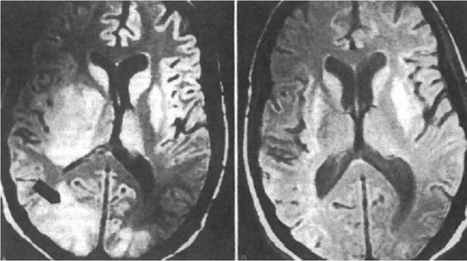 Hình 3: Ảnh chụp MRI não bệnh Toxoplasma thần kinh trung ương trước và sau khi điều trị