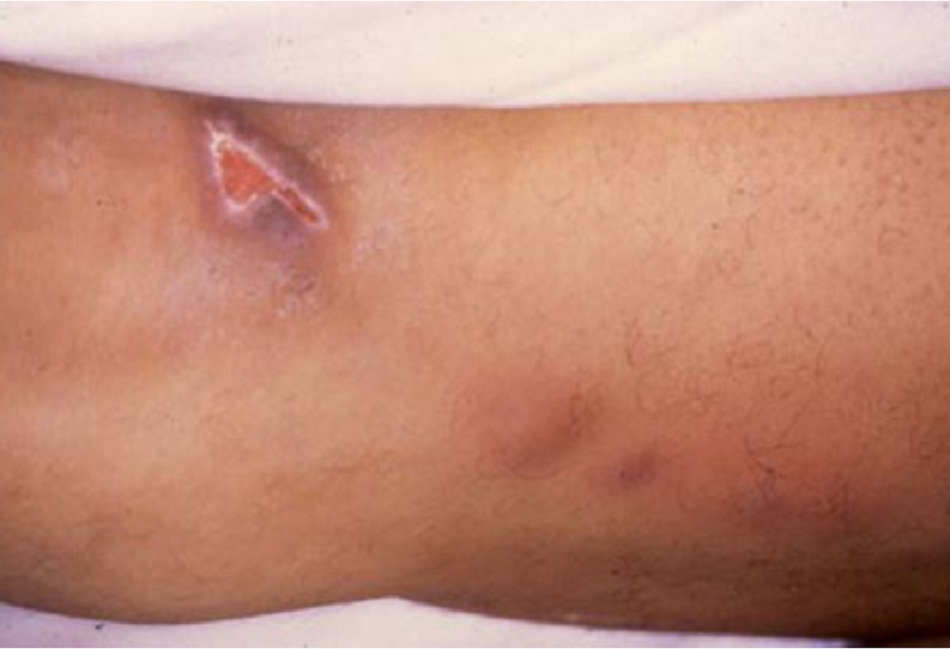 Hình 1: Bệnh tularaemia thể loét da ở chi dưới do ve cắn; loét ở xương bánh chè và sưng hạch bạch huyết phía trên là bằng chứng rõ rệt