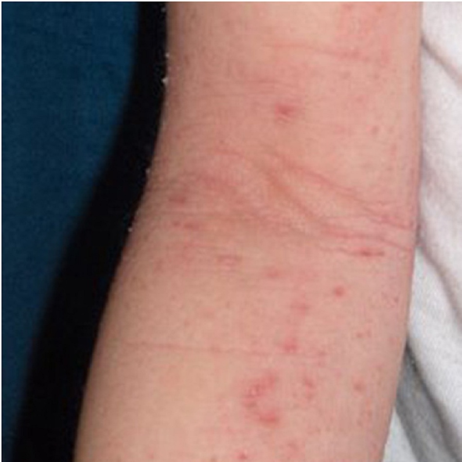 Hình 1: Chàm cấp tính ở khuỷu tay của một bé gái 9 tuổi