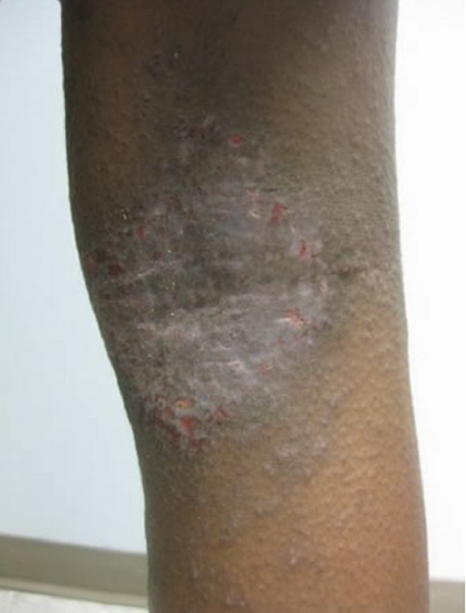 Hình 2: Lichen hóa hố khoeo ở trẻ bị chàm