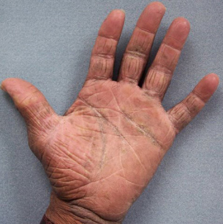 Hình 3: Chàm mạn tính ở lòng bàn tay của người đàn ông 64 tuổi