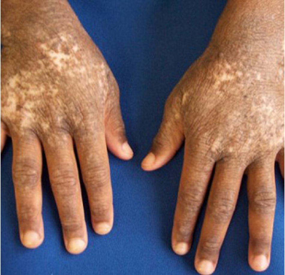 Hình 4: Giảm sắc tố ở phần mu bàn tay của bé gái 12 tuổi bị chàm