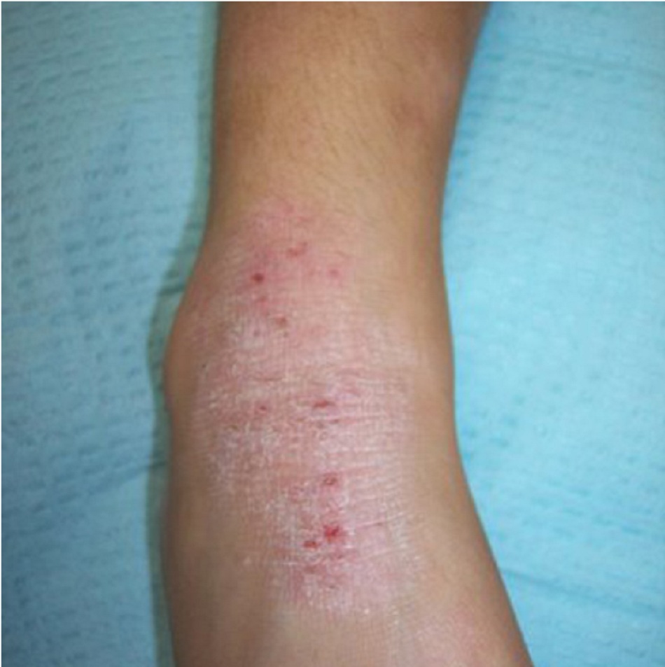 Hình 6: Giảm sắc tố ở vùng da có nếp gấp tại cổ chân của cùng bệnh nhân