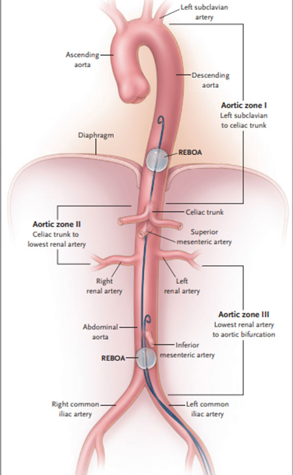 Figure 2. Resuscitative Endovascular Balloon Occlusion of the Aorta (REBOA). Shown are aortic occlusion zones. In zone I, safe positioning of the balloon for control of infradiaphragmatic hemorrhage is shown; in zone III, positioning for control of massive pelvic hemorrhage in the absence of a simultaneous abdominal source of hemorrhage is shown.