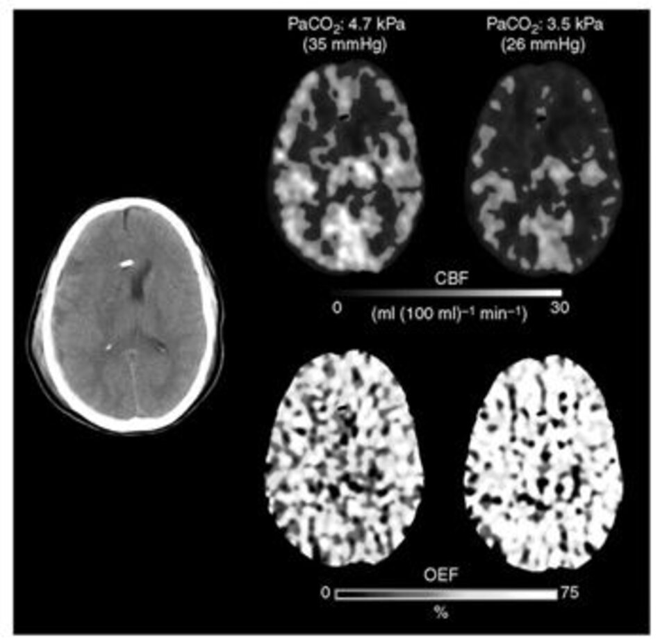 Hình 4. Hình ảnh CT Xenon cho thấy lưu lượng máu não (CBF) giảm và phân suất chiết xuất O2 (OEF) tăng sau khi tăng thông khí.