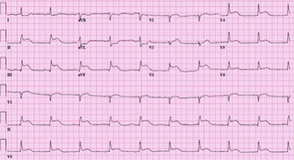Hình 1: Điên tim 12 chuyển đạo có hình ảnh ST chênh lên thành trước và thành dưới kèm theo các thay đổi đối ứng trong các chuyển đạo bên Tư liệu từ bác sĩ Mahi Ashwath; đã được phép sử dụng