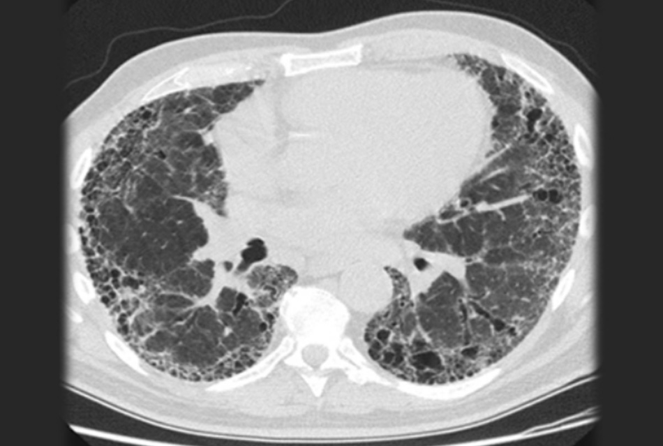 Hình 10: CT ngực có hình ảnh xơ phổi vô căn Tư liệu của Jeffrey C. Munson, MD, MS; đã được phép sử dụng