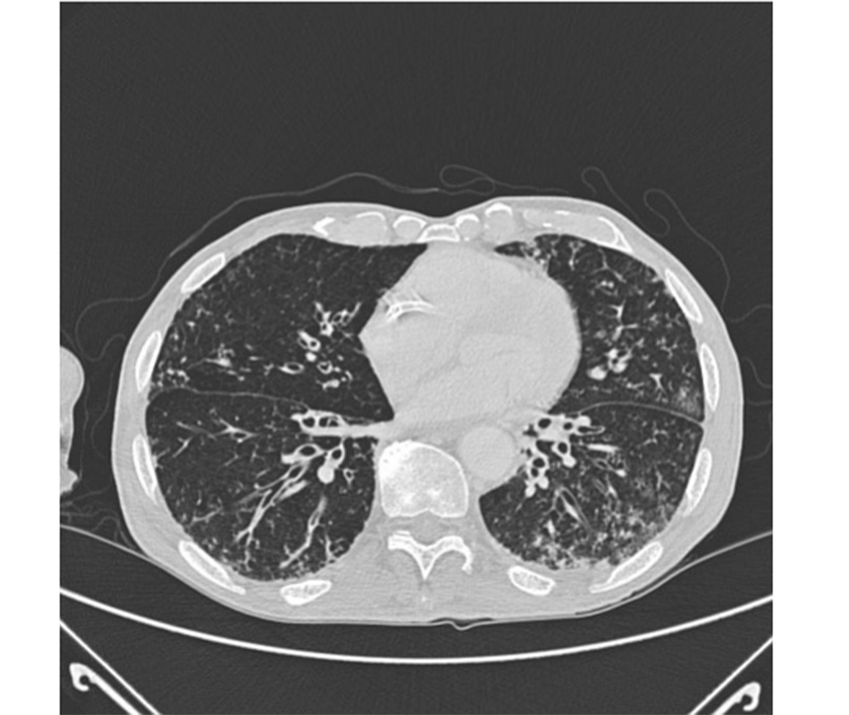 Hình 13: CT ngực có hình ảnh dày và giãn đường thở và hình ảnh chồi cây ở ngoại vi. Từ tài liệu của Bác sĩ Sangeeta M. Bhorade; được sử dụng với sự cho phép