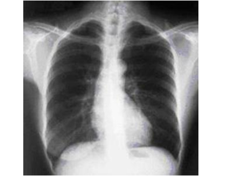 Hình 9: Xquang ngực cho thấy căng phồng phổi quá mức ở bệnh nhân COPD. Căng phồng phổi quá mức do khí phế thũng trong COPD, hơn l̀à do viêm phế quản mạn tính là nguyên nhân gây ho. Từ thông tin thu thập cá nhân của Tiến sĩ M. A. Sharifabadand, SUNY tại Trường Y của Đại học Stony Brook, Khoa Bệnh Phổi và Chăm sóc Tích cực, Mineola, New York và Tiến sĩ J. P. Parsons, Trung tâm Y khoa Đại học Tiểu bang Ohio, Columbus; đã được cho phép sử dung