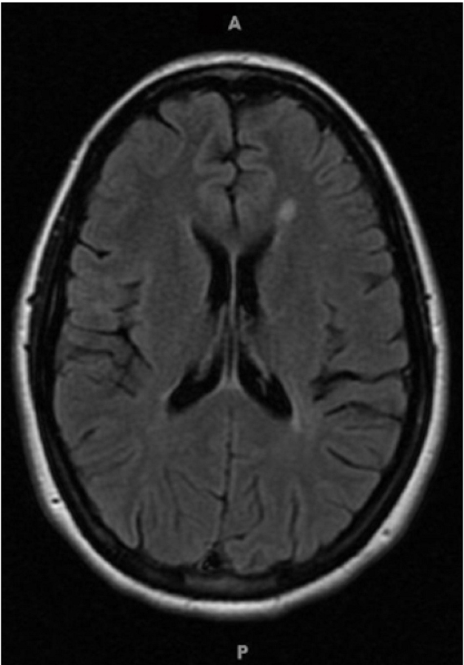 Hình 3: Tổn thương chất trắng điển hình chỉ ra nguy cơ đa xơ cứng (MRI)