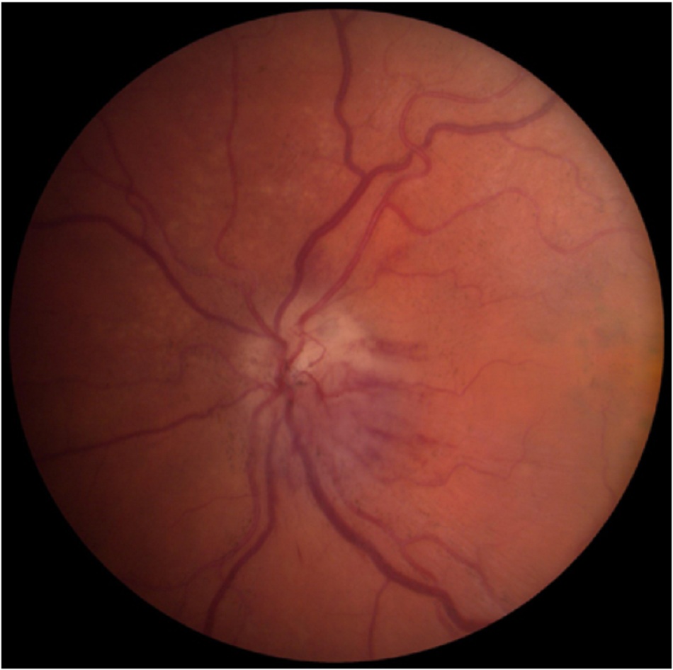Hình 4: Quan sát thấy xuất huyết và sưng đĩa thị giác phân đoạn ở bệnh nhân mắc bệnh thần kinh thị giác do thiếu máu cục bộ không do viêm động mạch
