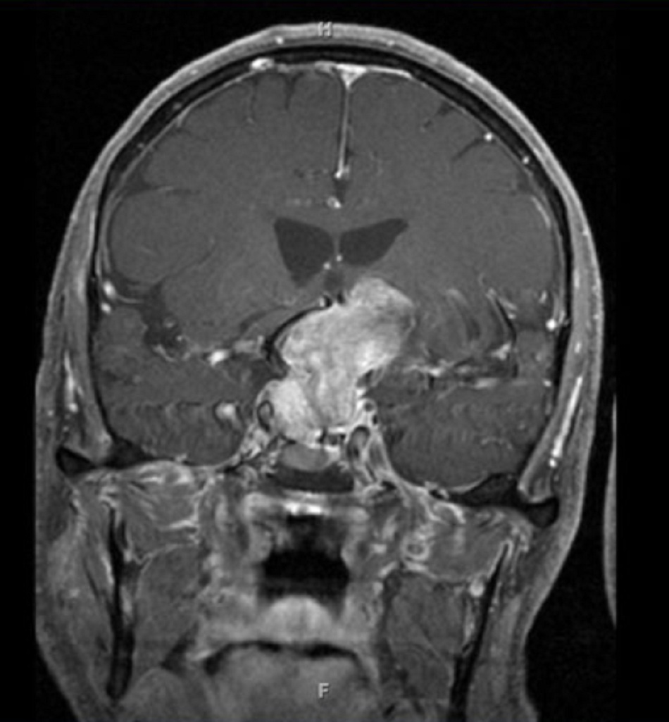 Hình 6: Xuất huyết tuyến yên: khối u lớn trên hố yên kèm theo tăng cường cản quang gadolinium không đồng nhất (MRI thiên về T1)