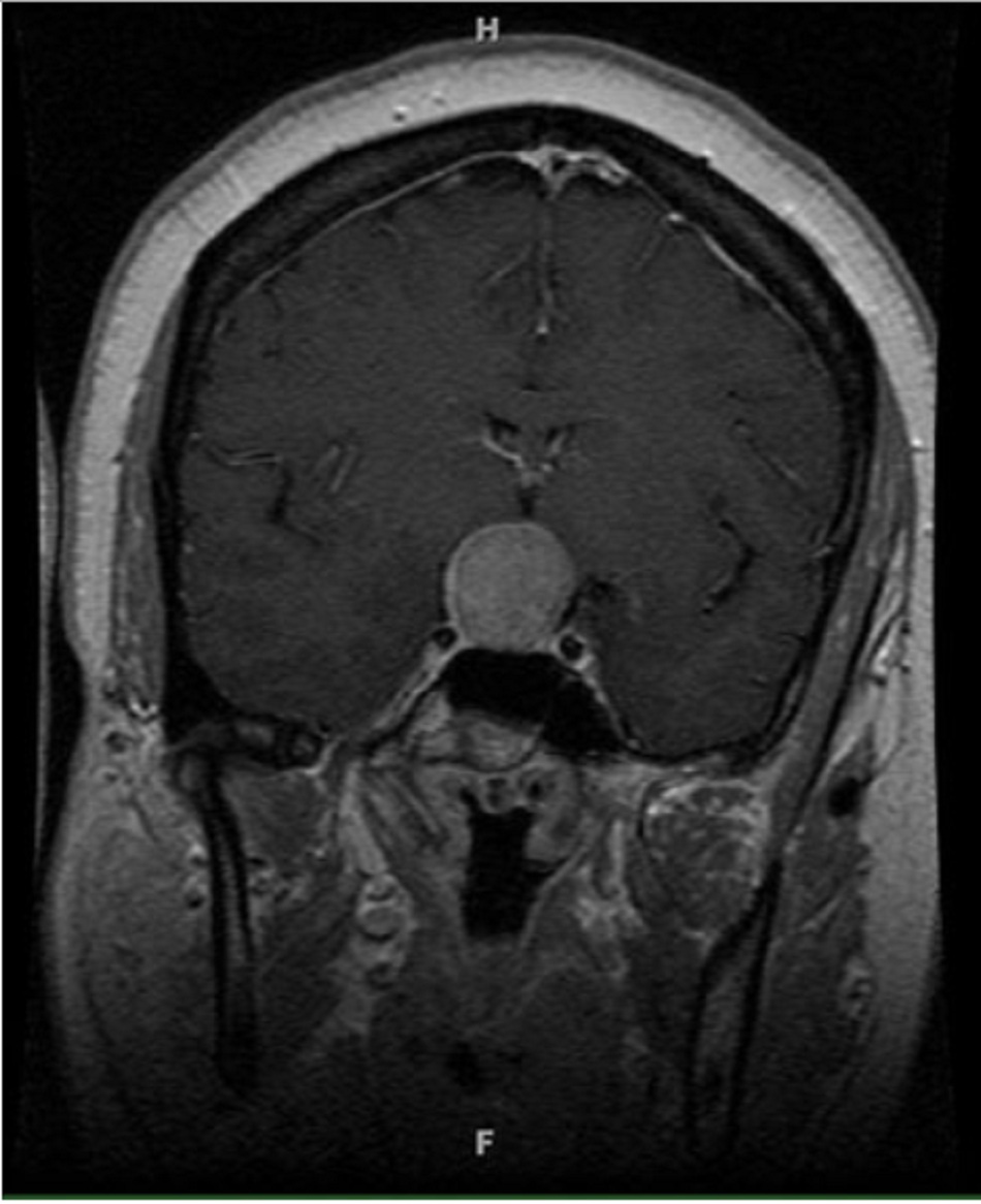 Hình 7: Khối u ở tuyến yên: khối u đồng nhất trên hố yên đẩy và đè nén lên giao thoa thị giác (MRI)