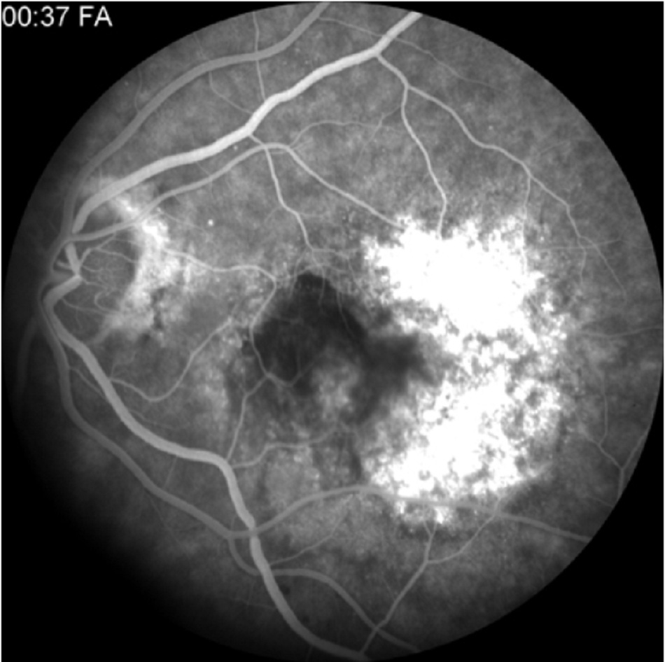 Hình 9: Chụp mạch máu nhuôm fluorescein chỉ ra hình thành màng tân mạch hắc mạc điển hình kèm theo tăng phát huỳnh quang sớm