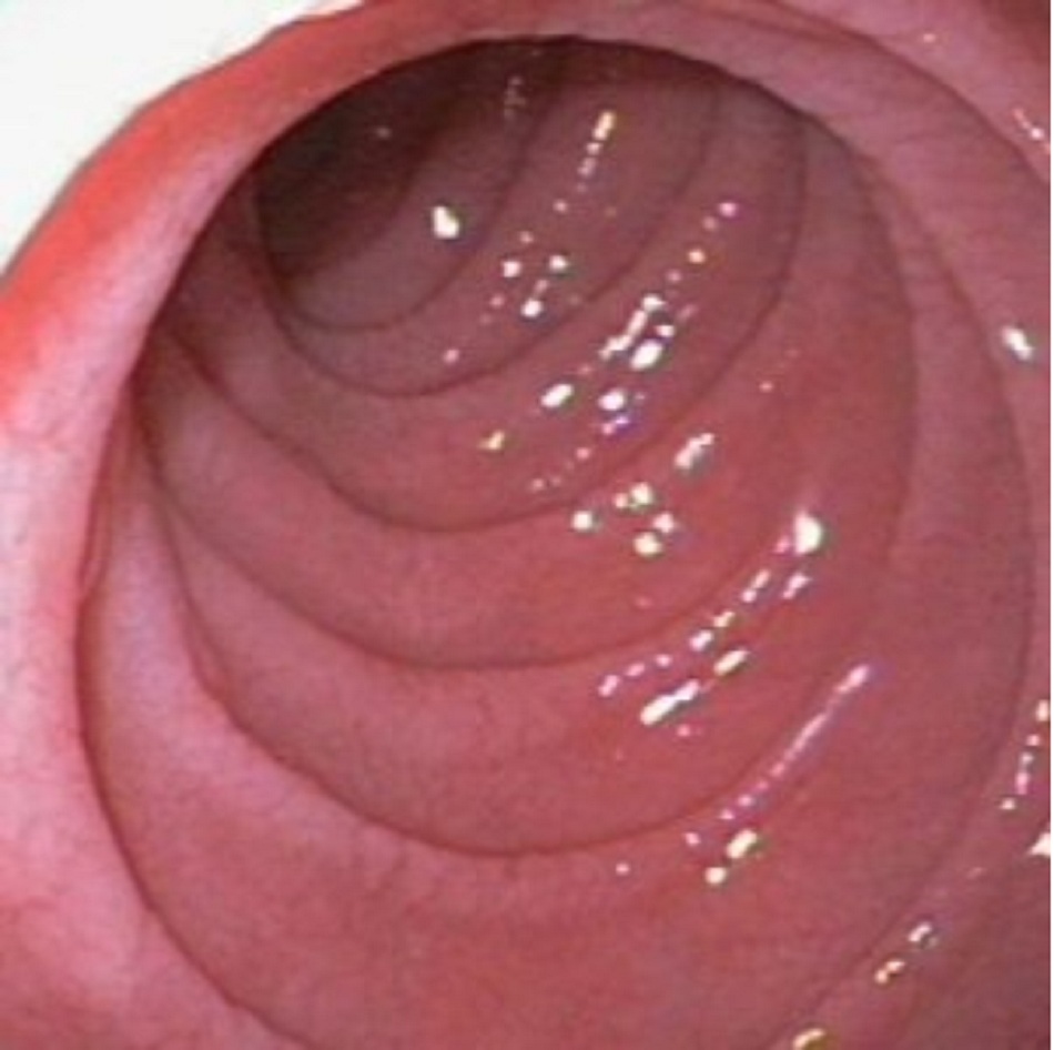 Hình 2: Endoscopic image of scalloping seen in the duodenal mucosa in coeliac disease and other mucosal disorders including giardiasis