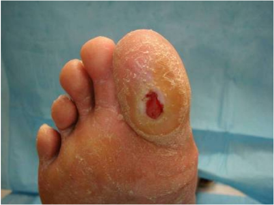 Hình 5: Loét gan bàn chân ở bệnh nhân bị đái tháo đường týp 1