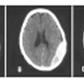 Tụ máu ngoài màng cứng: chụp CT não cho thấy vùng tăng mật độ dạng thấu kính hai mặt lồi nằm giữa màng cứng và hộp sọ. (A–C) Cùng một bệnh nhân ở các cấp độ khác nhau của hộp sọ, (A) là hầu hết phần đuôi và (C) hầu hết phần đầu van Dijk GW. Thần kinh học Thực hành. 2011;11(1):50­-55