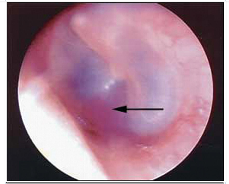 Hình 2: Xuất huyết hòm nhĩ: máu trong hòm nhĩ của tai giữa (mũi tên) van Dijk GW. Thần kinh học Thực hành. 2011;11(1):50-55