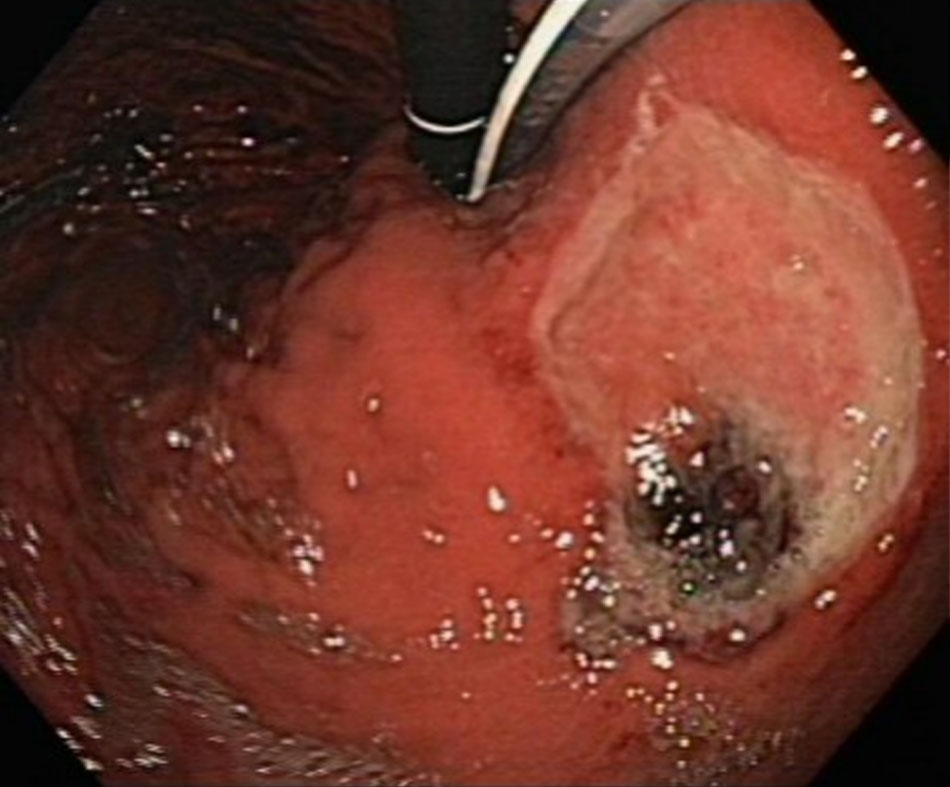 Hình 3: Vết loét dạ dày lớn có thể nhìn thấy mạch lớn nhô lên Từ những thu thập của Douglas G. Adler, MD
