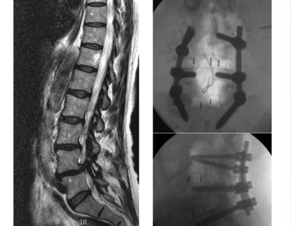 Hình 10: Hình trước và sau phẫu thuật: một bệnh nhân bị đau lưng và chứng đau cách hồi do thần kinh kèm hẹp và trượt thoái hóa ở L4-5 và thoái hóa đĩa đệm tại L5S1 (MRI dọc giữa thiên về T2, bên trái); thực hiện giải phóng chèn ép L4-S1 và hợp nhất dùng dụng cụ và hợp nhất liên thân đốt sống thắt lưng qua foramen 2 mức (x-quang trước sau trên đỉnh; bên, đáy) Từ thông tin thu thập của Bác sĩ N. Quiraishi