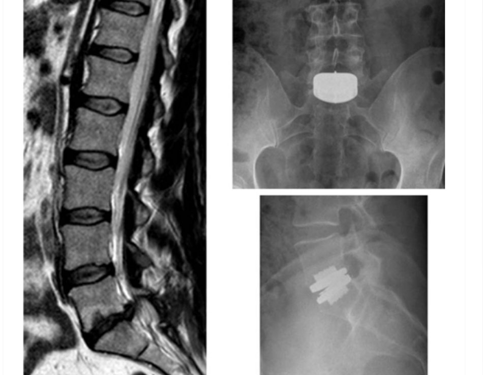 Hình 11: Thay đĩa: bệnh nhân tới khám với tình trạng đau lưng nặng, trước đây đã cắt bỏ đĩa L5S1 bên phải vì bệnh rễ thần kinh S1 bên phải. Mặc dù ban đầu đã phục hồi, đau S1 bên phải đã tái phát sau 10 tháng, kèm đau lưng. Chụp MRI cho thấy thoái hóa đĩa L5S1 (hình chiếu dọc giữa thiên về T2, bên trái). Bệnh nhân sau đó đã thay đĩa đệm (x-quang trước sau trên cùng bên phải, bên dưới cùng bên phải). Cơn đau ở lưng và chân phải đã khỏi hẳn Từ thông tin thu thập của Bác sĩ N. Quiraishi